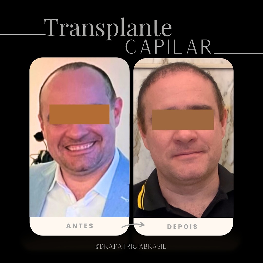 Antes x depois patricia 4